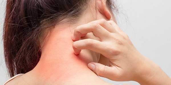 أكثر 9 اسباب لظهور حبوب في الجسم مع حكة