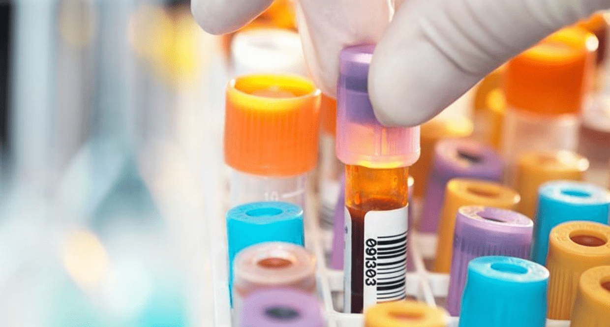 ماهو تحليل lupus anticoagulant
